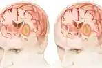 Tak Semua Tumor Otak Perlu Dioperasi, Ini yang Perlu Dipahami Pasien dan Keluarga