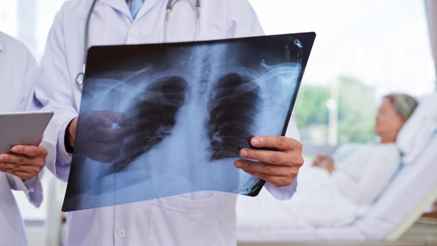 Kasus Pneumonia di Pontianak Meningkat Imbas Asap Karhutla