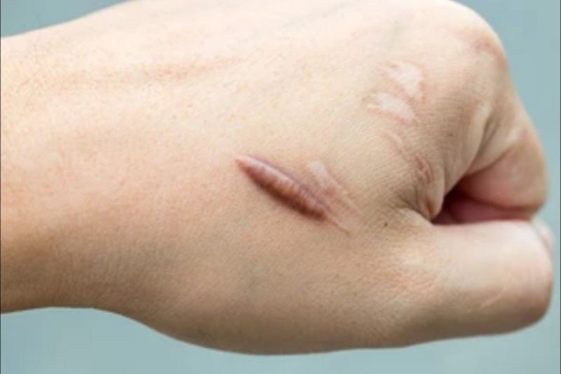 Bolehkah luka jahitan diberi povidone iodine? Ini penjelasannya