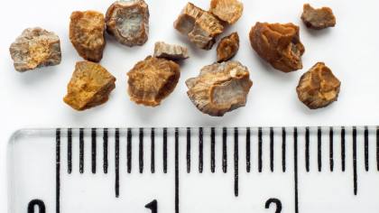 Dokter Keluarkan Batu Kandung Kemih 3,1 Kg dari Pasien
