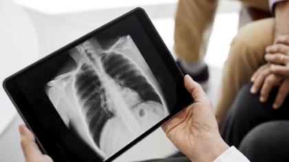 Paparan Asap Karhutla bisa Picu Pneumonia, Begini Prosesnya