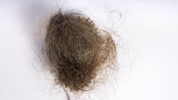 Gadis AS Muntah Hebat, Dokter Temukan Gumpalan Rambut 1,5 Kg