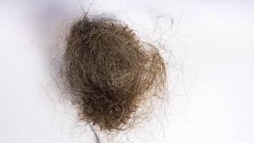 Gadis AS Muntah Hebat, Dokter Temukan Gumpalan Rambut 1,5 Kg