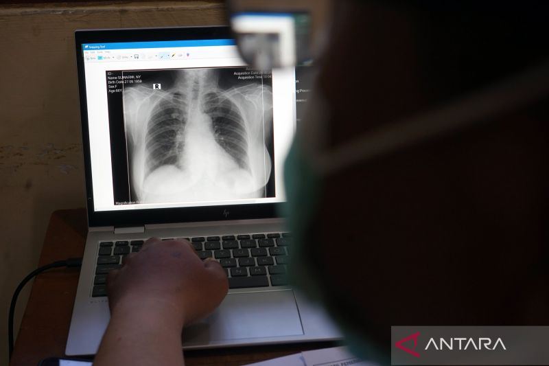 AI membaca rontgen, memburu TBC sebelum terlambat